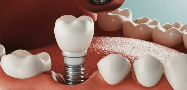 Transforming Smiles: The Ultimate Guide to Dental Implants