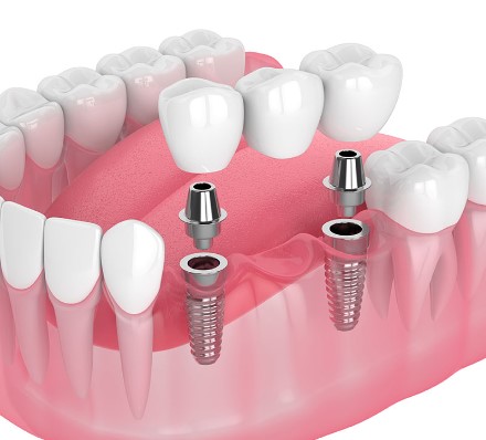 Transforming Smiles The Ultimate Guide To Dental Implants, smile makeover, dental restoration, cosmetic dentistry, dental transformation, implant dentistry, dental reconstruction, oral rehabilitation, smile enhancement, dental makeover, smile rejuvenation, tooth replacement, dental restoration, dental rehabilitation, dental transformation, dental prosthesis, dental cosmetic surgery, smile restoration, dental aesthetics, smile reconstruction, dental rejuvenation, smile improvement, dental revolution, dental smile guide, dental implantology
